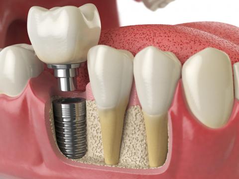 Implant Supported Restorations